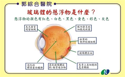 眼睛有波紋|眼睛出現不明閃光是視網膜剝離前兆？